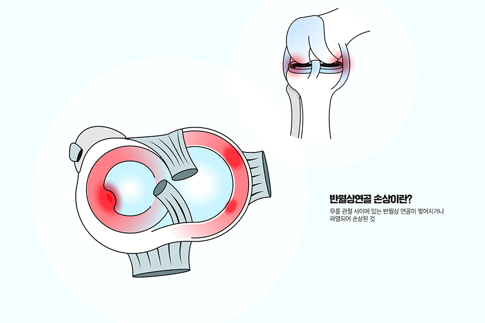 무릎 관절염 이미지