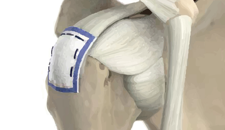 패치봉합술 이미지