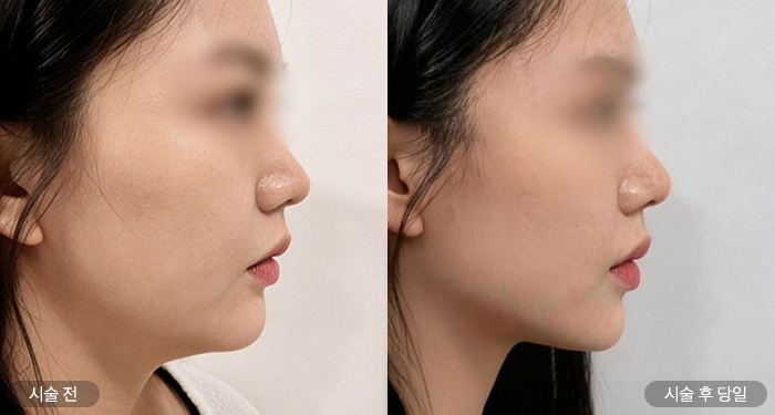 줄기세포 울쎄라