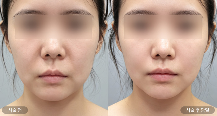 줄기세포 울쎄라