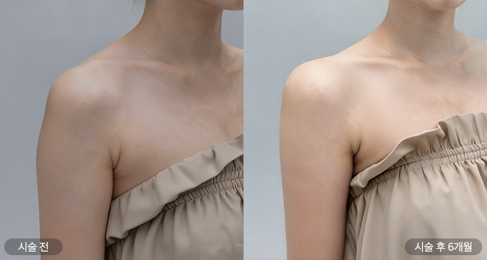 어깨필러 40cc(측면)