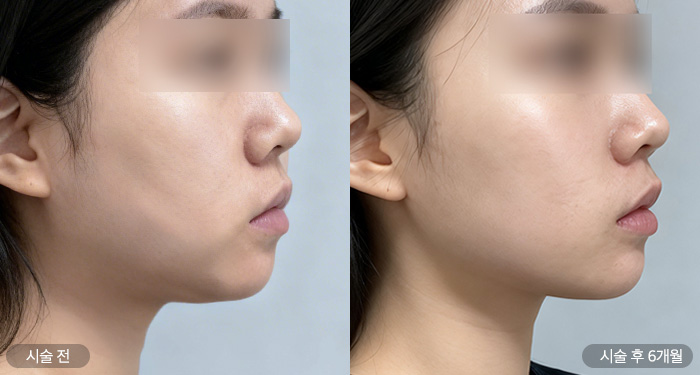 온다 리프팅 (50KJ 3회)