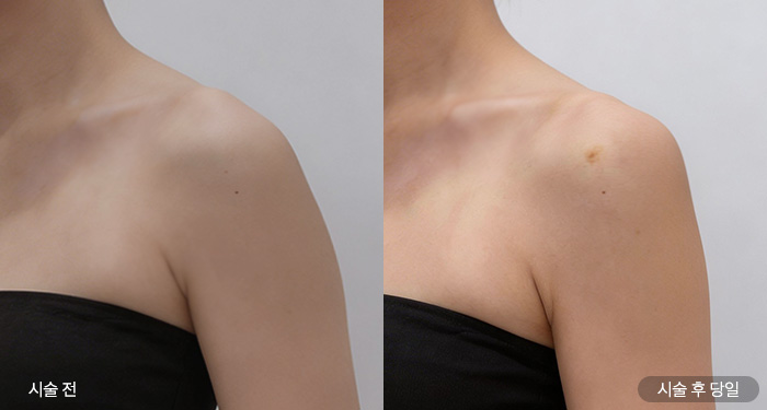 어깨필러 40cc (측면)