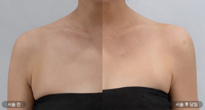 어깨필러 40cc (정면)