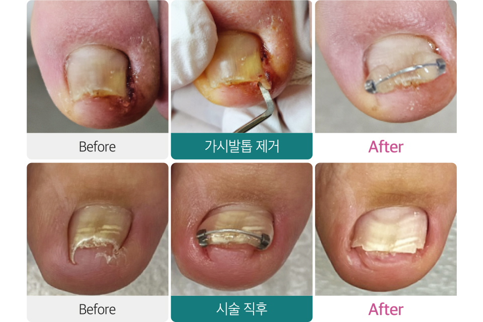 내성발톱 치료 이미지