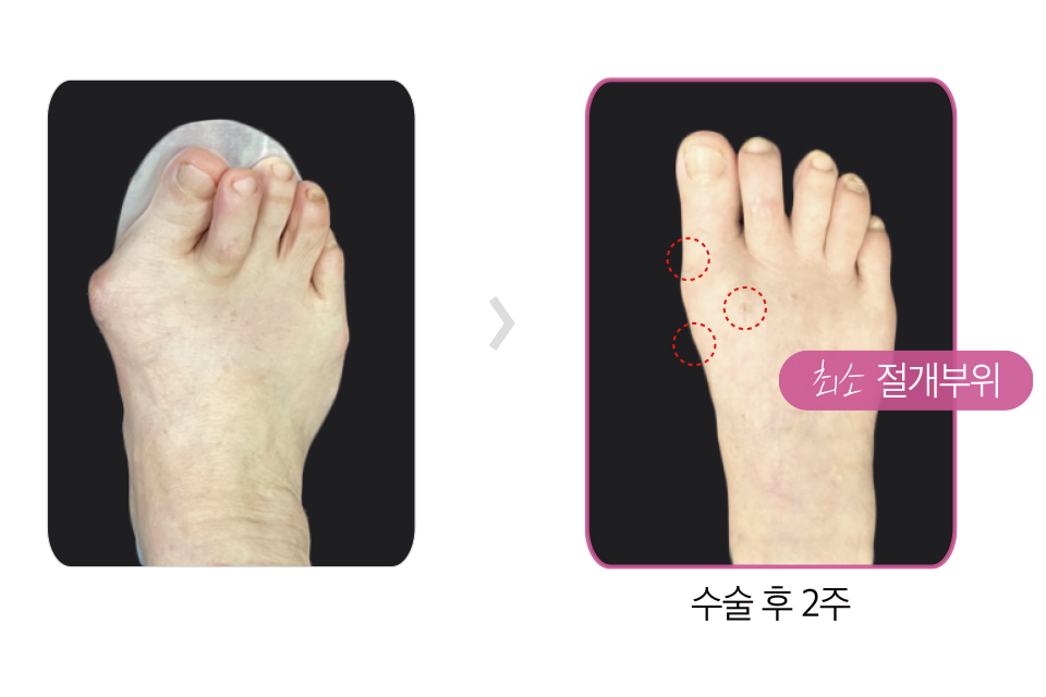 무지외반증 수술 이미지