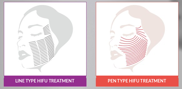 Liftera 2: How It Works, Key Benefits, and Post-Treatment Care Published | Augus