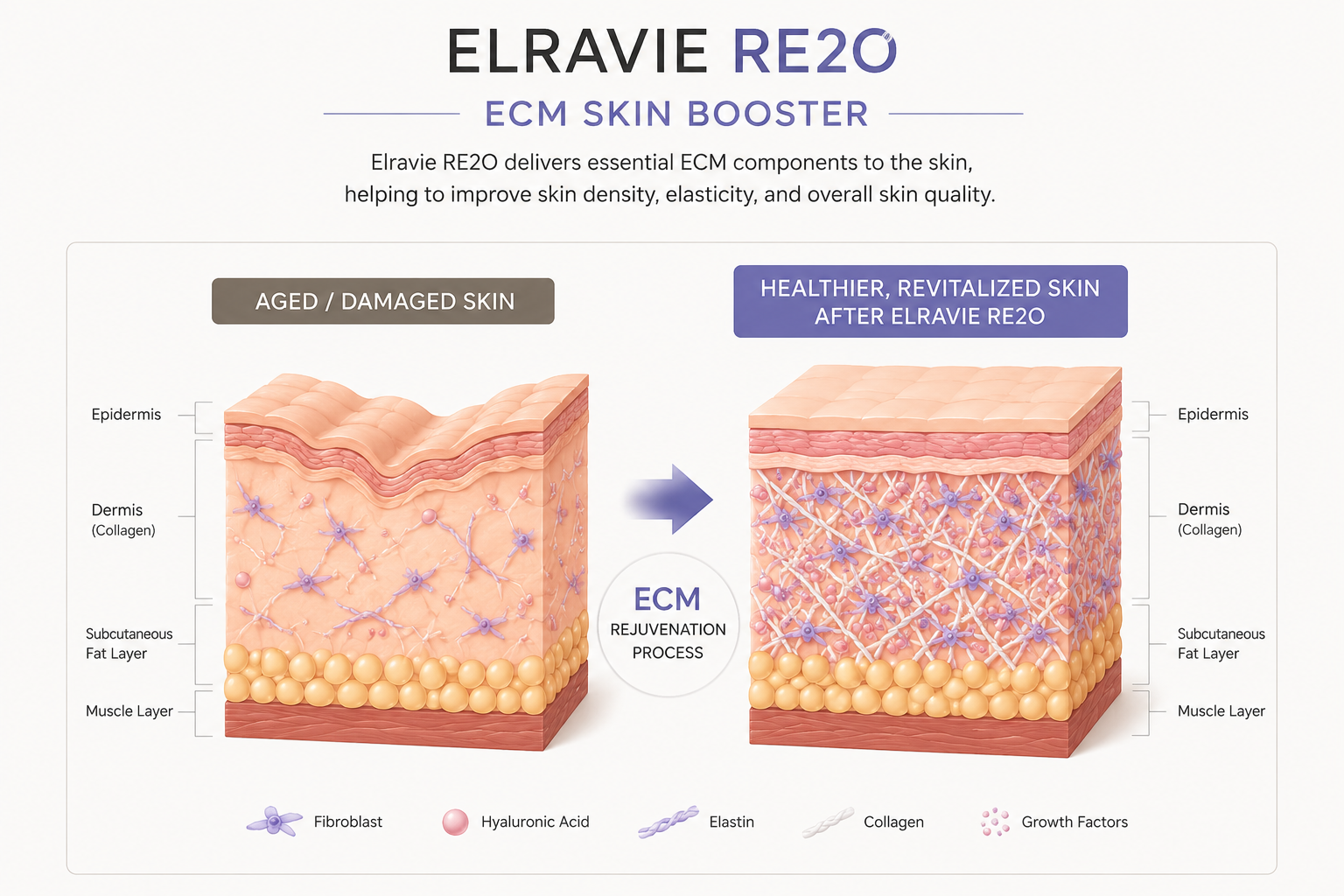 Elravie Re2O: How Is It Different from Conventional Skin Boosters? Published | J