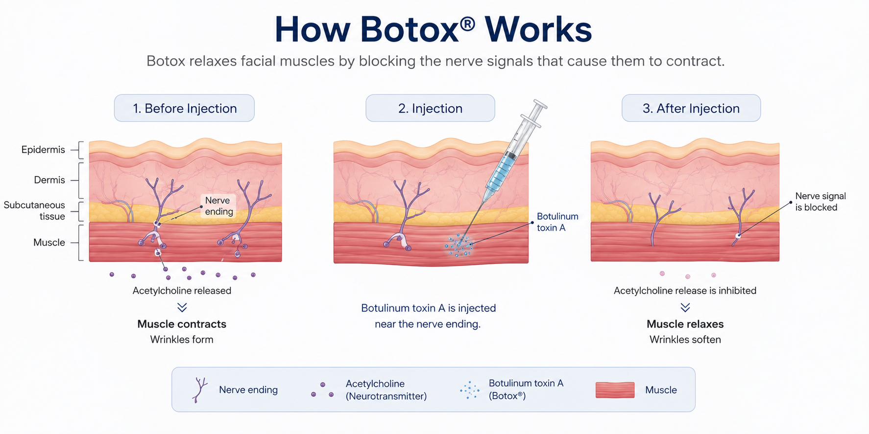 How Do Wrinkles Become Deeper?The Relationship Between Facial Muscles and Skin A