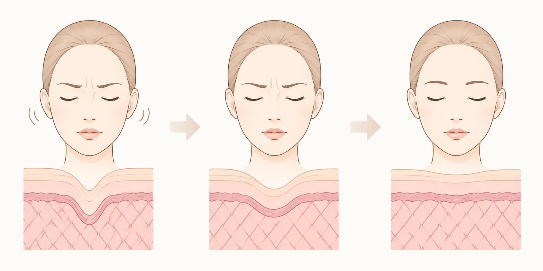 How Do Wrinkles Become Deeper?The Relationship Between Facial Muscles and Skin A