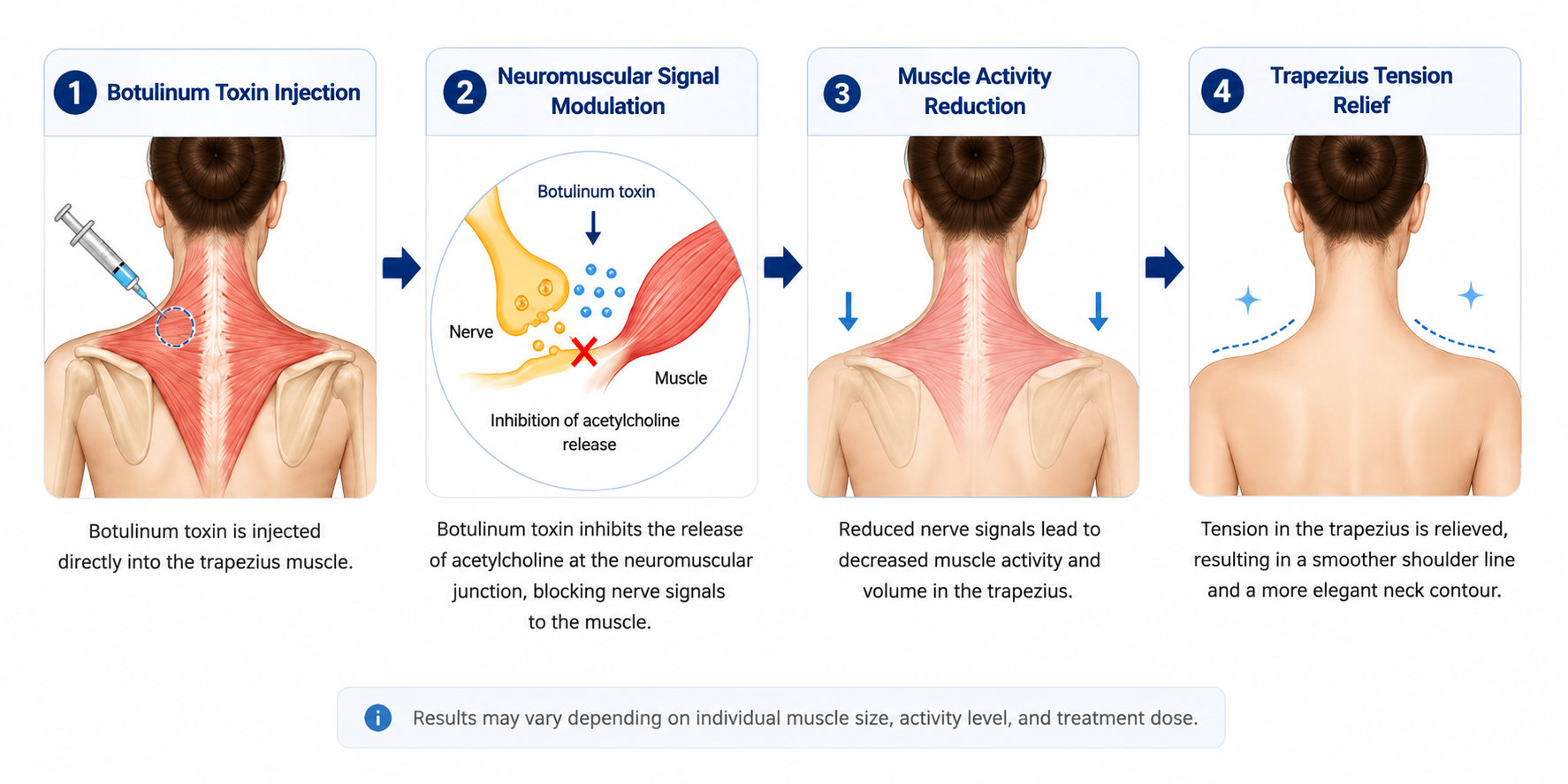 Trapezius Botox for a Slimmer Shoulder Line Published: August 18, 2026 | Last Up