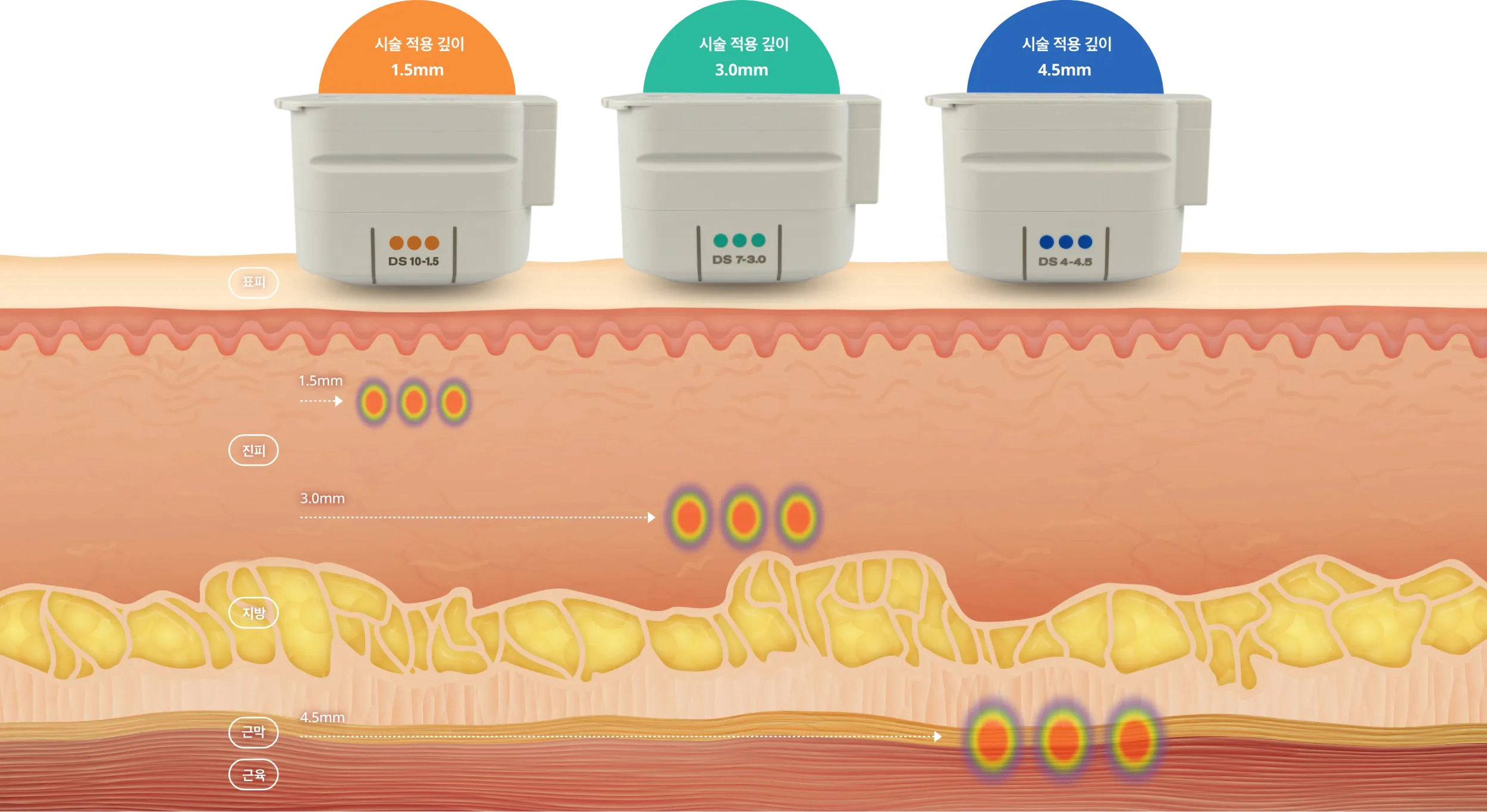 Why Is It Important for Ultherapy PRIME to Reach the SMAS Layer? Published | Aug