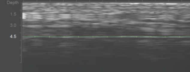 Ultherapy Prime: The One Thing More Important Than the Procedure Itself Hello, t