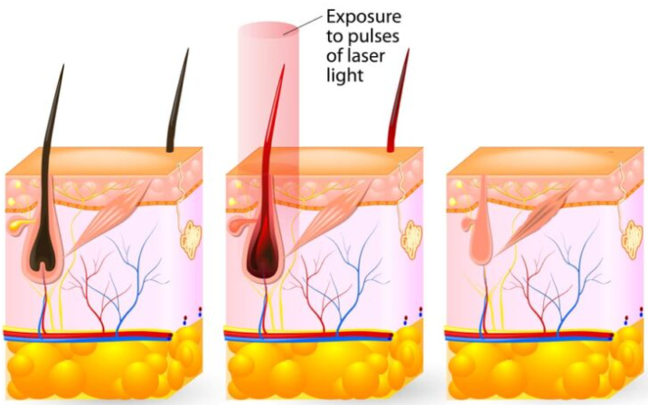 Men’s Laser Hair Removal: Achieving a Cleaner Look Hello, this is nbom Clinic. R