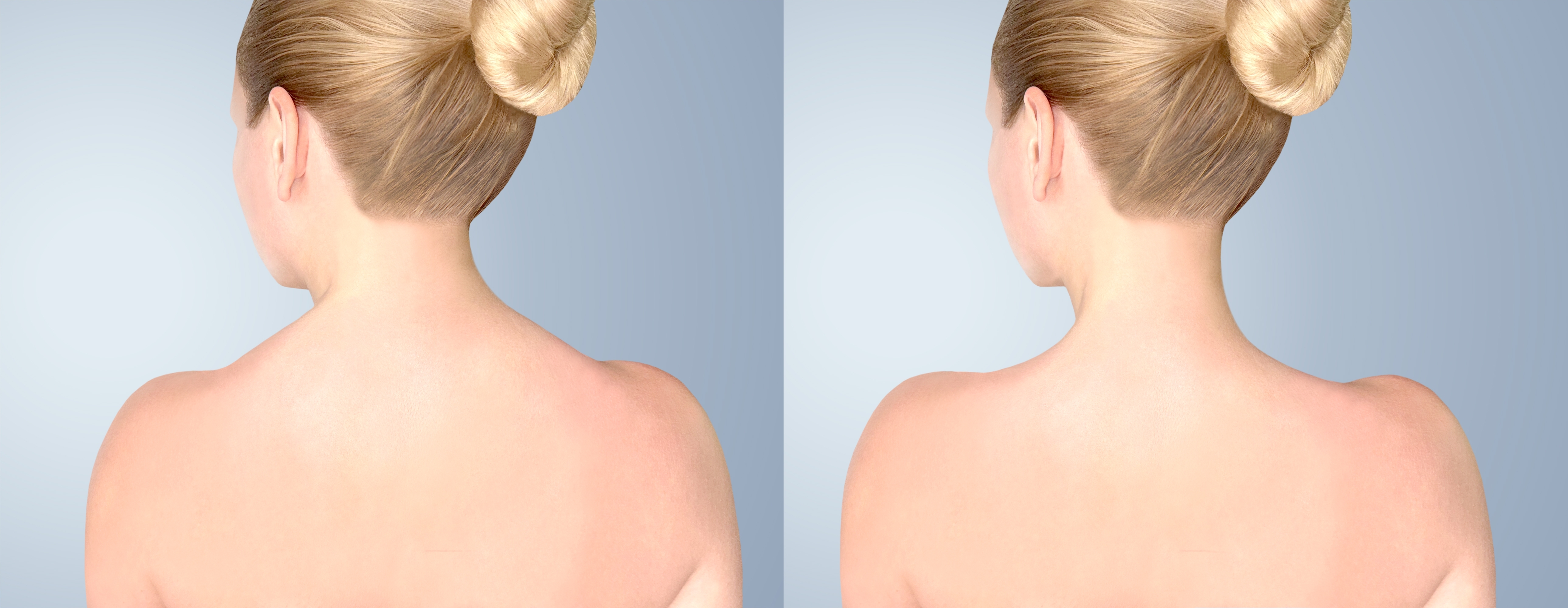 “Trapezius Botox: Are You Ready for an Attractive Shoulder Line This Coming Summ