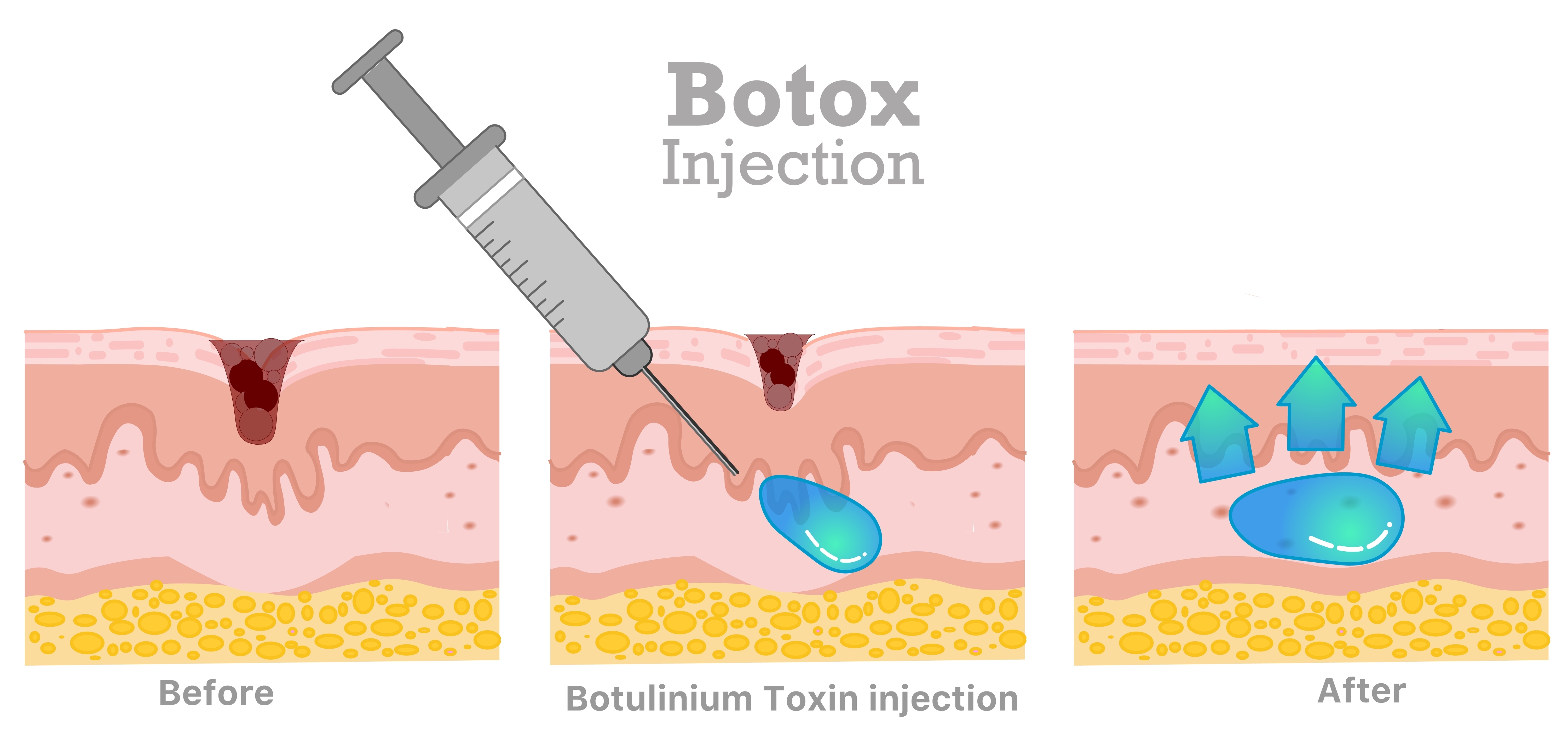 "Wrinkle Botox: Perfect Comparison of Treatable vs Untreatable Wrinkles & Recomm