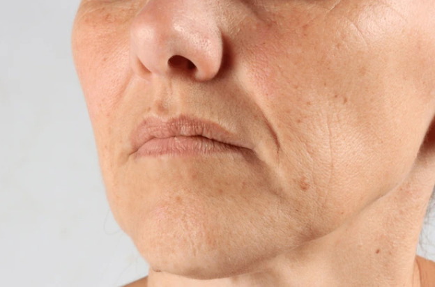"Wrinkle Botox: Perfect Comparison of Treatable vs Untreatable Wrinkles & Recomm