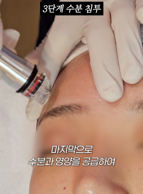 Guide to the 3-Step Aqua Peel Procedure Hello, this is nbom Clinic. Today, we wo