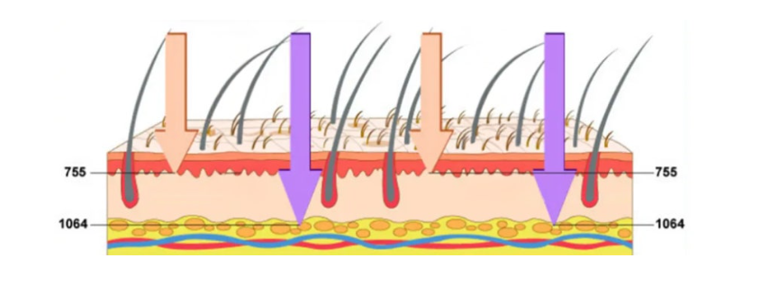 Laser Hair Removal: Why You Should Focus on the Hair Follicle Rather Than the Ha