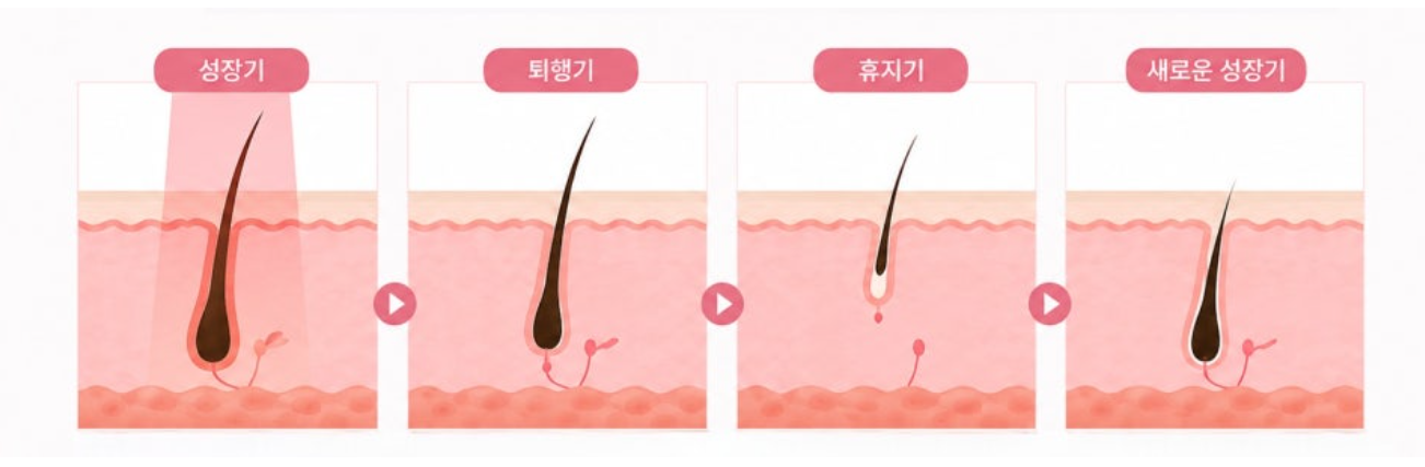 Laser Hair Removal Session Count? How Many Should I Get? Hello. This is nbom Cli