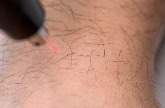 Laser Hair Removal : 'Doing it Right' is More Important Than the Laser Equipment