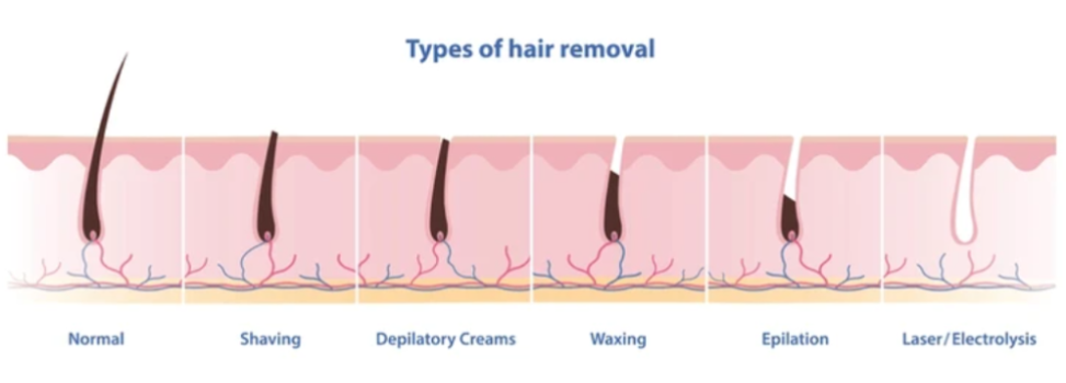Laser Hair Removal: Why You Should Focus on the Hair Follicle Rather Than the Ha