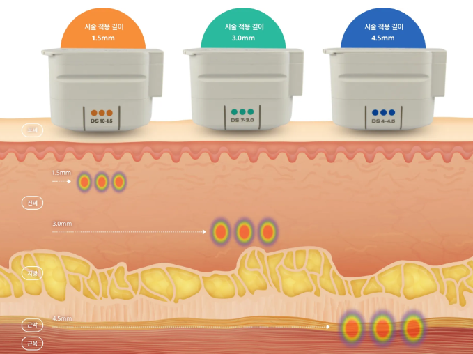 Ultherapy Prime Effects: When Will You Notice a Difference? Hello, this is nbom 