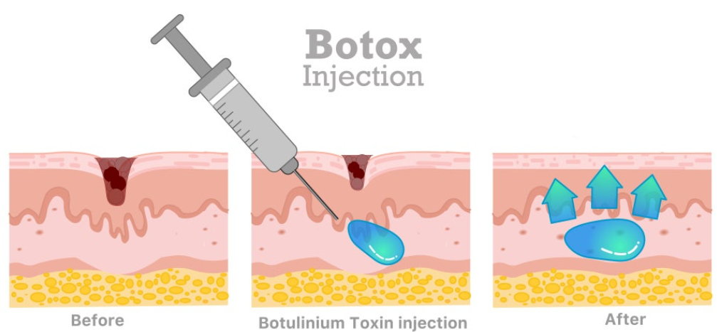 Hyperhidrosis Botox: How to Deal with Summer's Biggest Headache—Excessive Sweat?