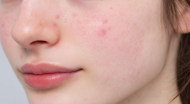How to Maximize the Effects of Aqua Peel and Lala Peel: Is 'This' the Right Answ